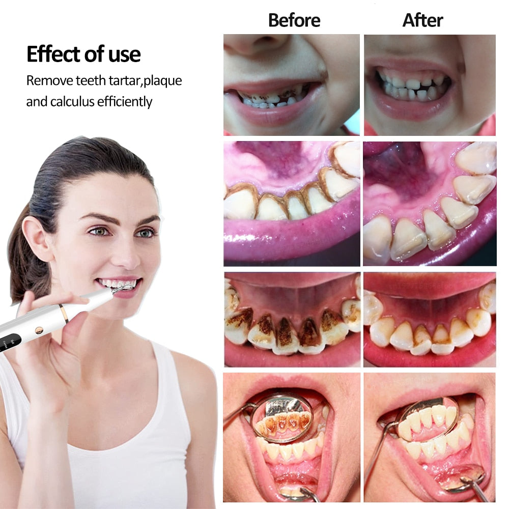 Ultrasonic Dental Teeth Plaque Cleaner